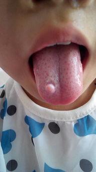 吃瓜舌头烂了图片,舌头“中招”的趣味瞬间-第1张图片-国产精品黑料吃瓜网曝